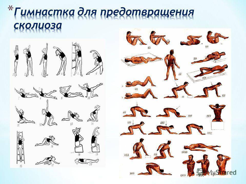 Упражнения при сколиозе позвоночника — гимнастика для спины
