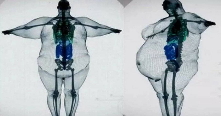 Широкая кость: есть ли оправдание большому весу от скелета? широкая кость и ожирение: развенчиваем мифы как понять что у тебя широкая кость